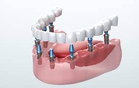 Why You Need To Visit a New York Dentist for Dental Implants